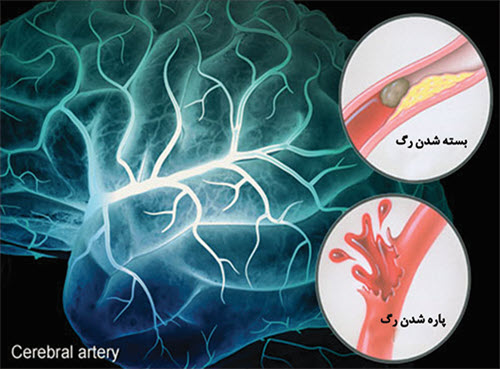 سكته مغزی
